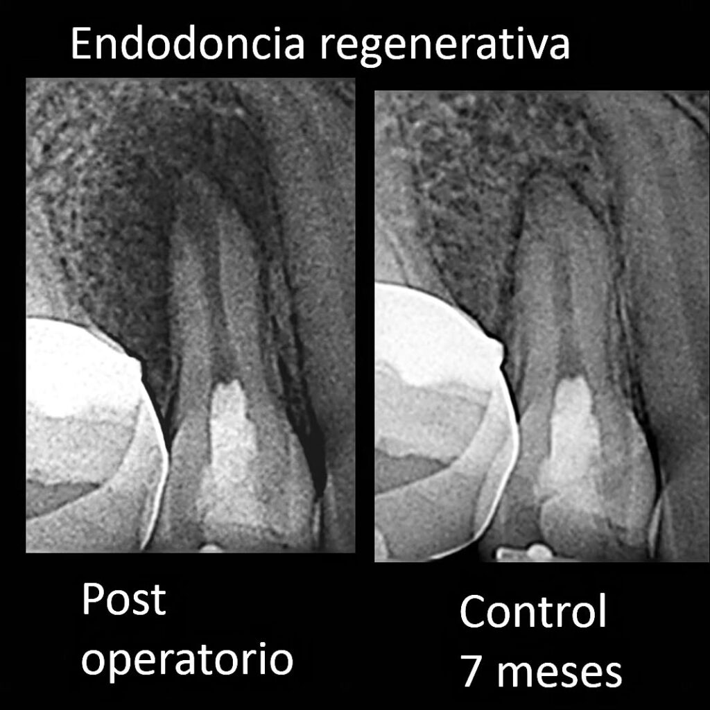 Endodoncia Regenerativa