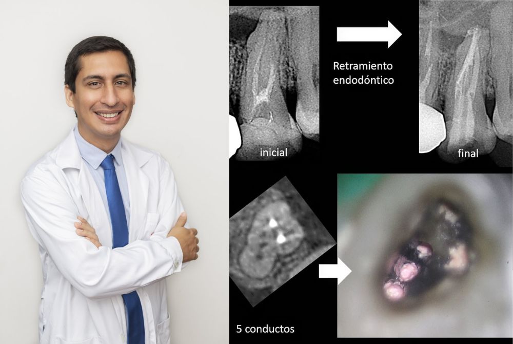 Retratamiento endodóntico