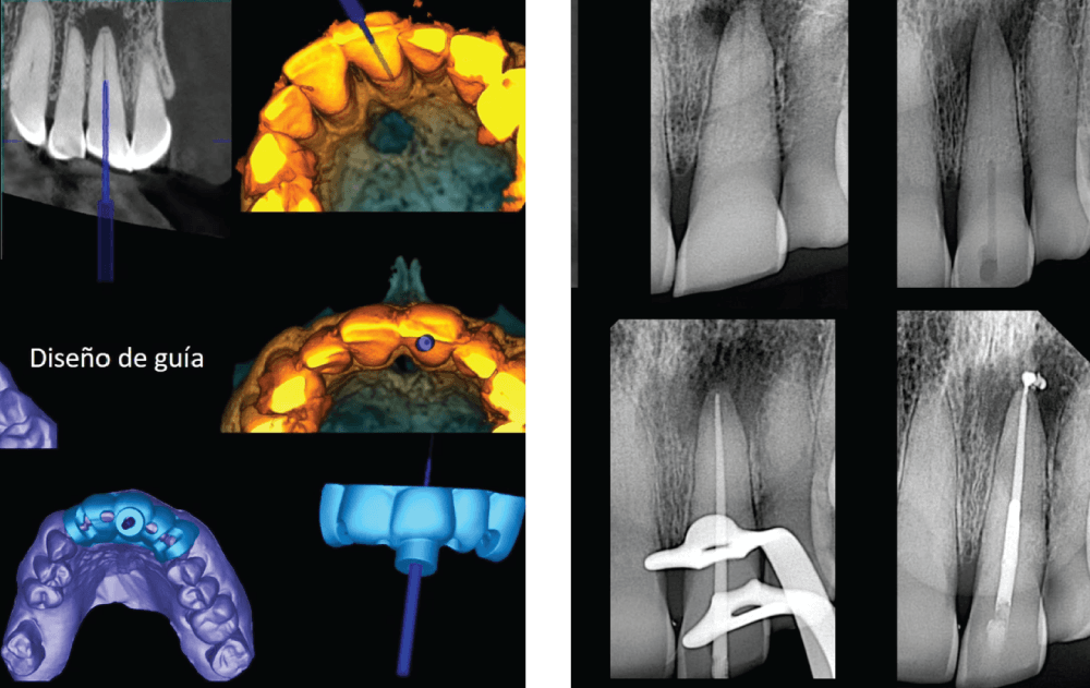 Casos clínicos: Endodoncia guiada
