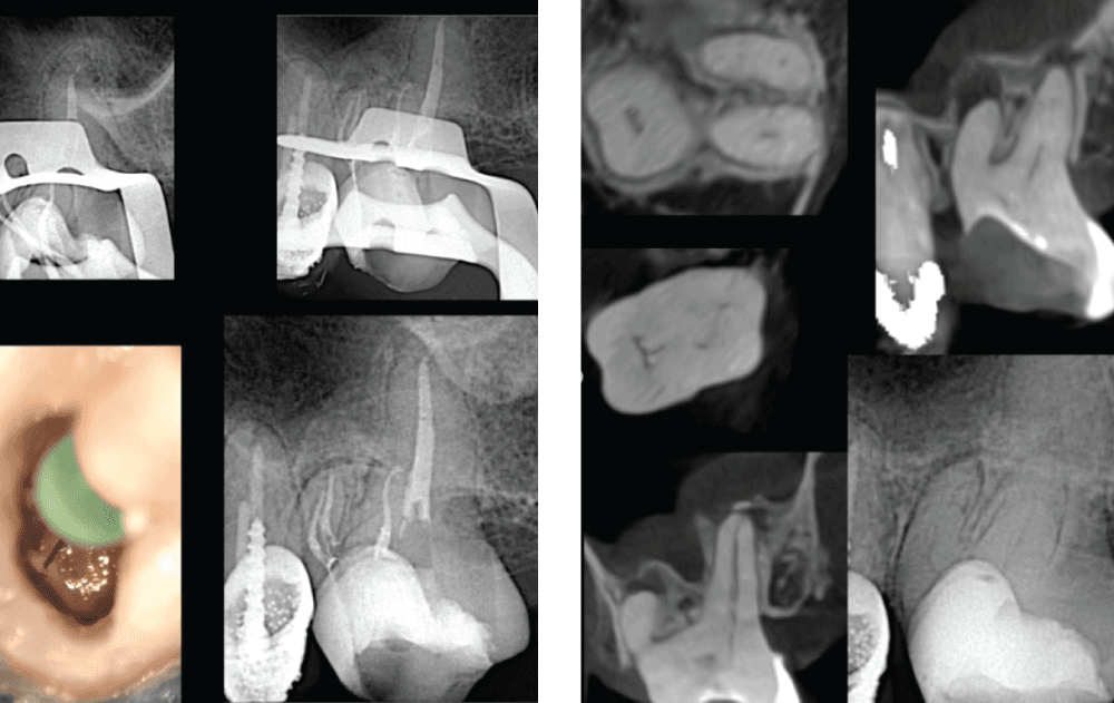 Lesión Apical, caso clínico complejo